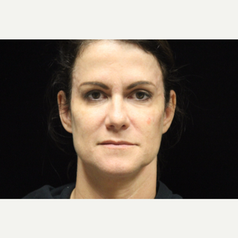 45-54 year old woman treated with Liquid Facelift before 3502624