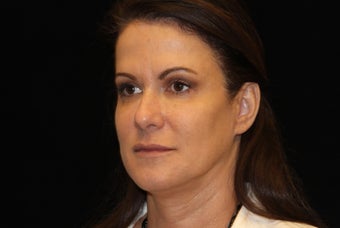45-54 year old woman treated with Liquid Facelift 3502624