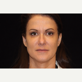 45-54 year old woman treated with Liquid Facelift after 3502624