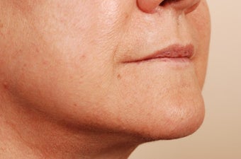 Lip Implants before 1159473