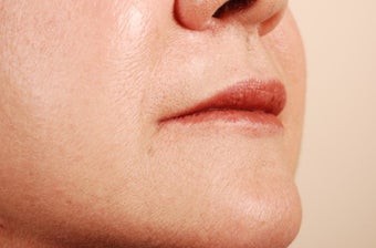 Lip Implants after 1159473