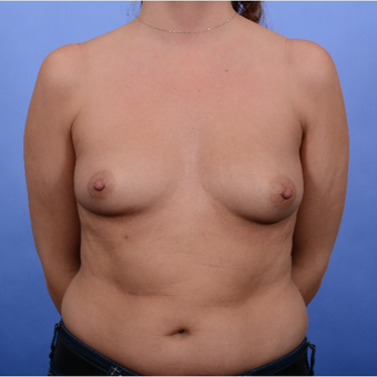 Breast Augmentation (465gm) before 3052386