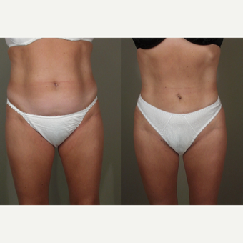 25-34 year old woman treated with Liposuction before 3659129