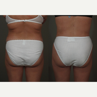 25-34 year old woman treated with Liposuction after 3659129