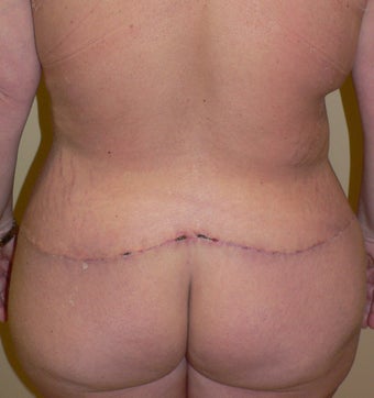 46 year old woman has Belt Lipectomy 984181