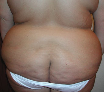 46 year old woman has Belt Lipectomy 984181