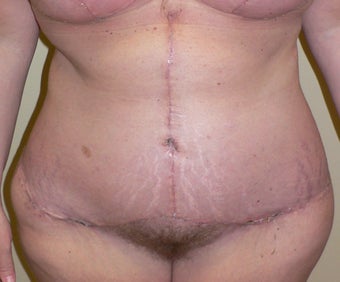 46 year old woman has Belt Lipectomy after 984181