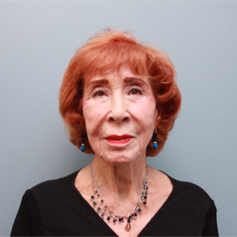 83 year old spunky woman treated with a lower facelift before 3544511