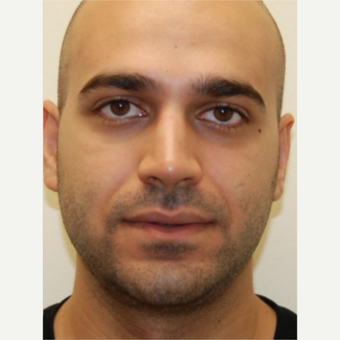 18-24 year old man treated with Rhinoplasty after 3143587