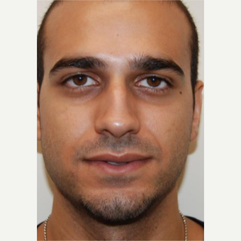 18-24 year old man treated with Rhinoplasty before 3143587