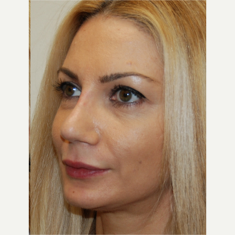 35-44 year old woman treated with Rhinoplasty after 3388022
