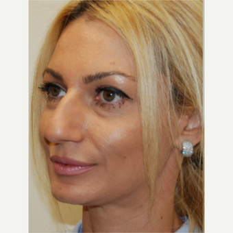 35-44 year old woman treated with Rhinoplasty before 3388022