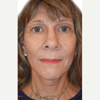 58 year old woman treated with facial fat grafting after 2870089