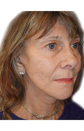 58 year old woman treated with facial fat grafting 2870089
