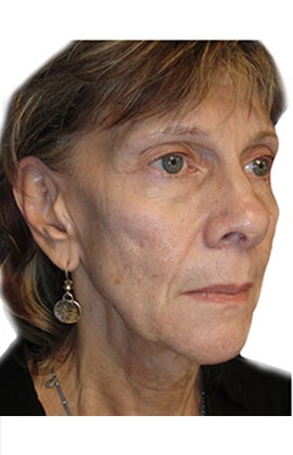 58 year old woman treated with facial fat grafting 2870089