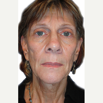 58 year old woman treated with facial fat grafting before 2870089