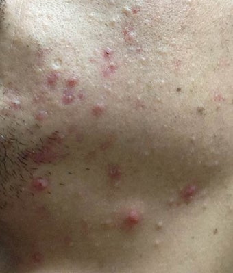 Accutane before 975886