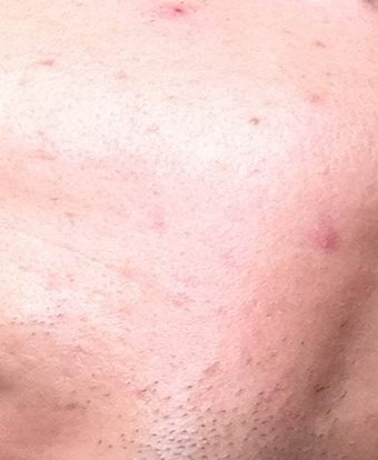 Accutane after 975886