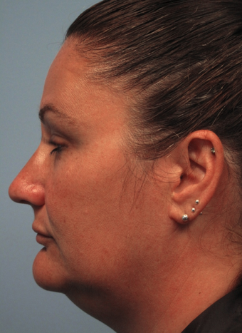 Exilis before 424075