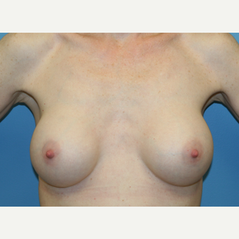 42 year old woman treated with Breast Augmentation after 3486786