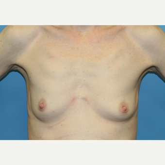 42 year old woman treated with Breast Augmentation before 3486786