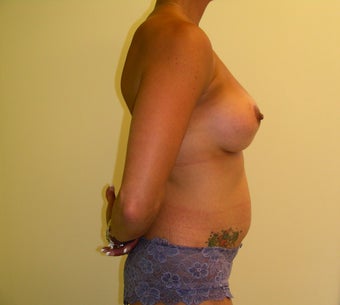 Mommy Makeover 1652436