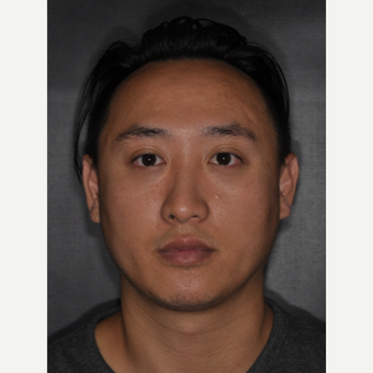 35-44 year old man treated with Septoplasty 8 months post-op after 3499961