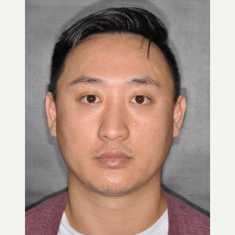 35-44 year old man treated with Septoplasty 8 months post-op before 3499961