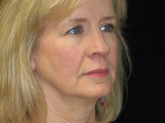 45-54 year old woman treated with Facelift, quad blepharoplasty 2509180