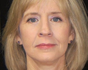 45-54 year old woman treated with Facelift, quad blepharoplasty after 2509180