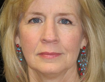 45-54 year old woman treated with Facelift, quad blepharoplasty before 2509180