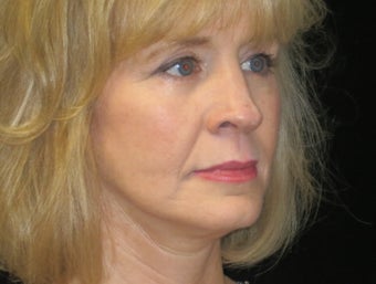 45-54 year old woman treated with Facelift, quad blepharoplasty 2509180