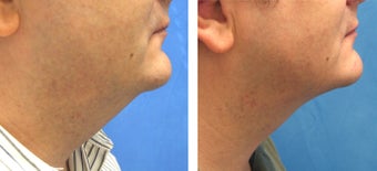 Male Treated for Chin Liposuction before 1010778