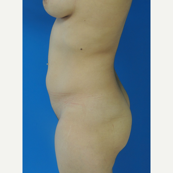 25-34 year old woman treated with Brazilian Butt Lift before 3107892