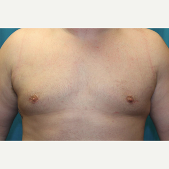 25-34 year old man treated with Male Breast Reduction after 3129072