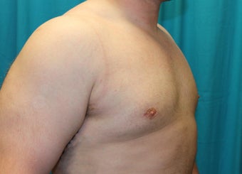 25-34 year old man treated with Male Breast Reduction 3129072