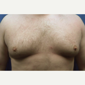 25-34 year old man treated with Male Breast Reduction before 3129072