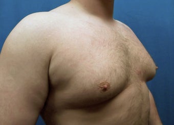 25-34 year old man treated with Male Breast Reduction 3129072