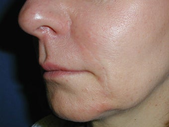 Radiesse for Nasolabial Folds after 100935