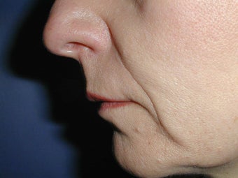 Radiesse for Nasolabial Folds before 100935