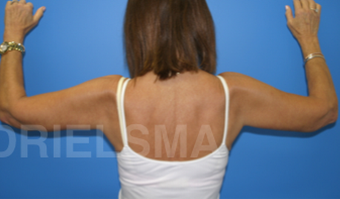 Bilateral Brachiopalsty 1467563
