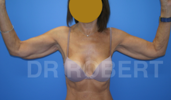 Bilateral Brachiopalsty before 1467563