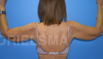 Bilateral Brachiopalsty 1467563