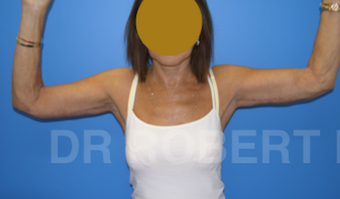 Bilateral Brachiopalsty after 1467563