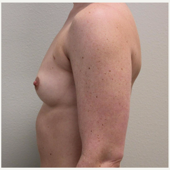 25-34 year old woman treated with Breast Augmentation before 3425221