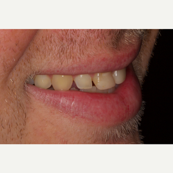 25-34 year old man treated with Porcelain Veneers before 2696770