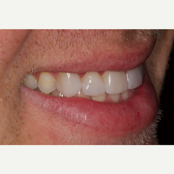 25-34 year old man treated with Porcelain Veneers after 2696770