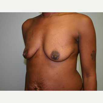 Breast Augmentation before 3560729