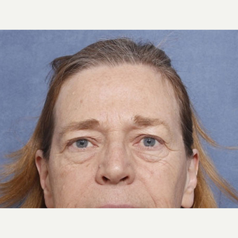 55-64 year old woman treated with Eyelid Surgery (view 1 of 2) before 3180570