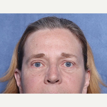 55-64 year old woman treated with Eyelid Surgery (view 1 of 2) after 3180570